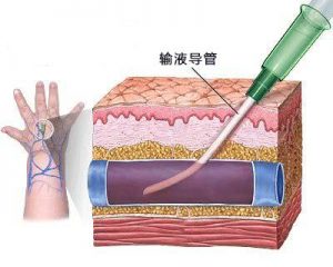 圖8. 靜脈注射示意